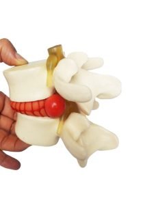 Modelo-Columna-Hernia-Discal.jpg